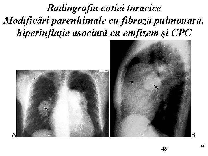 Radiografia cutiei toracice Modificări parenhimale cu fibroză pulmonară, hiperinflaţie asociată cu emfizem şi CPC
