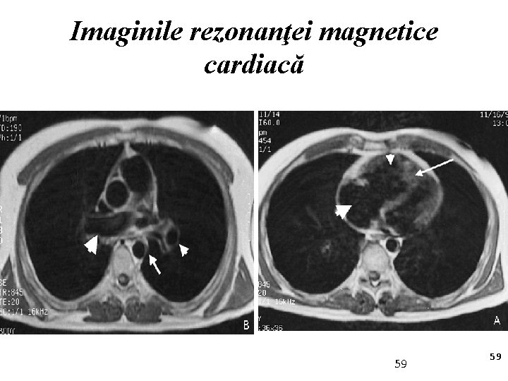 Imaginile rezonanţei magnetice cardiacă 59 59 