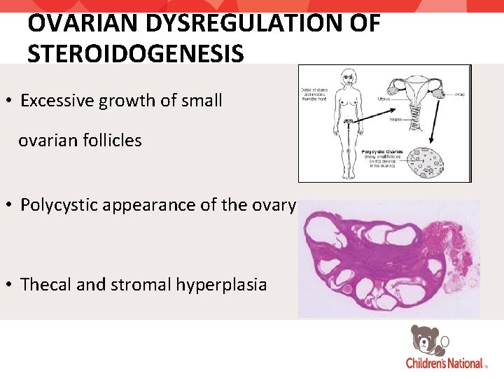 OVARIAN DYSREGULATION OF STEROIDOGENESIS • Excessive growth of small ovarian follicles • Polycystic appearance