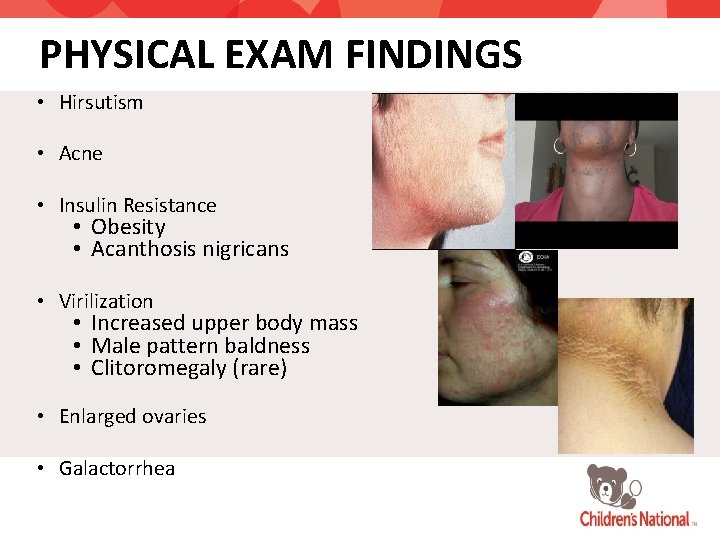 PHYSICAL EXAM FINDINGS • Hirsutism • Acne • Insulin Resistance • Obesity • Acanthosis