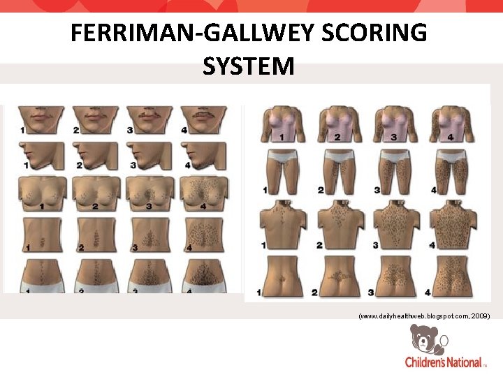 FERRIMAN-GALLWEY SCORING SYSTEM (www. dailyhealthweb. blogspot. com, 2009) 