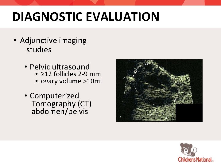 DIAGNOSTIC EVALUATION • Adjunctive imaging studies • Pelvic ultrasound • ≥ 12 follicles 2