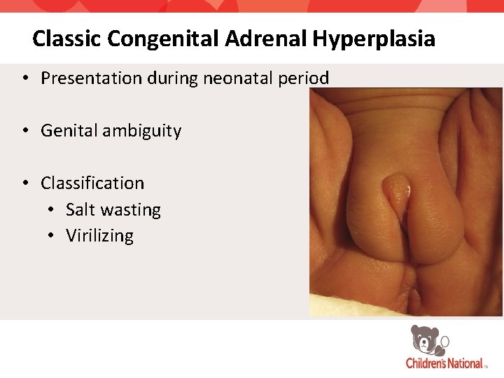Classic Congenital Adrenal Hyperplasia • Presentation during neonatal period • Genital ambiguity • Classification