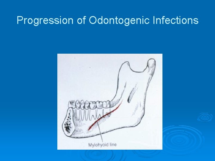 Progression of Odontogenic Infections 