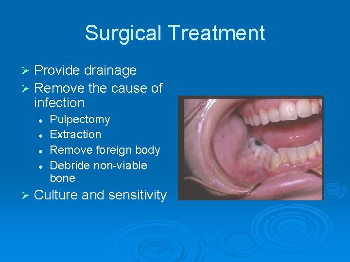 Surgical Treatment Provide drainage Ø Remove the cause of infection Ø l l Ø