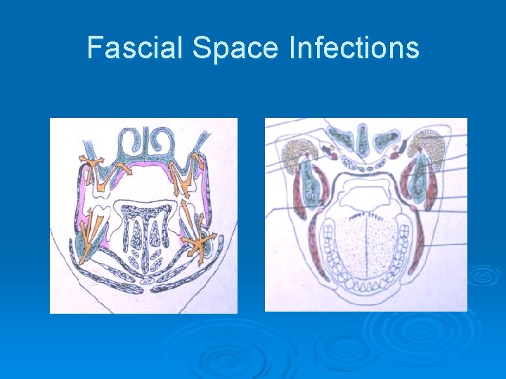 Fascial Space Infections 