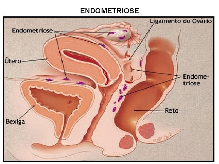 ENDOMETRIOSE 