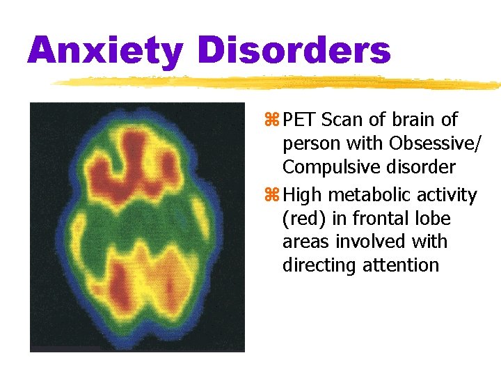 Anxiety Disorders z PET Scan of brain of person with Obsessive/ Compulsive disorder z Anxiety Disorders z PET Scan of brain of person with Obsessive/ Compulsive disorder z