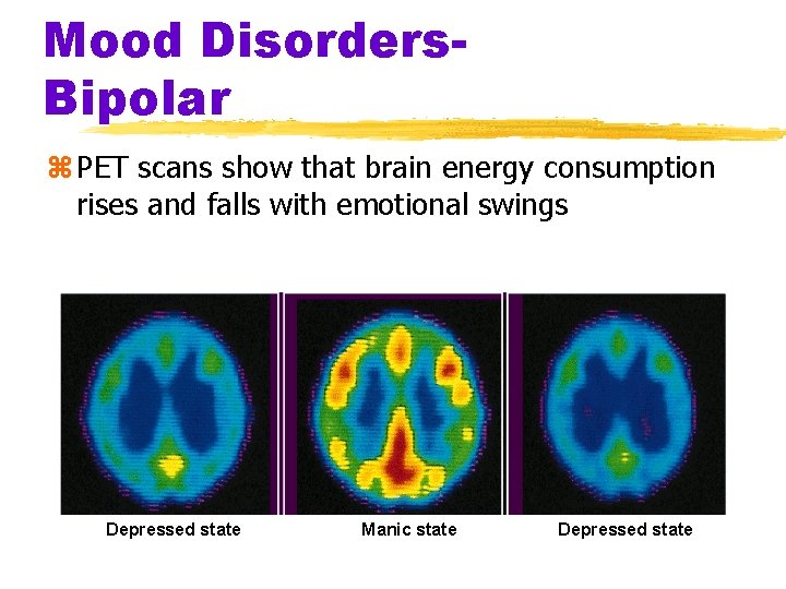 Mood Disorders. Bipolar z PET scans show that brain energy consumption rises and falls Mood Disorders. Bipolar z PET scans show that brain energy consumption rises and falls