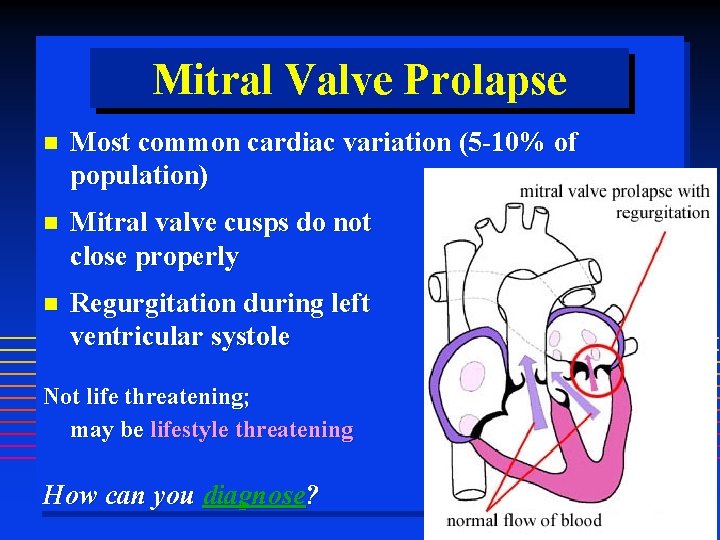 Mitral Valve Prolapse Most common cardiac variation (5 -10% of population) Mitral valve cusps