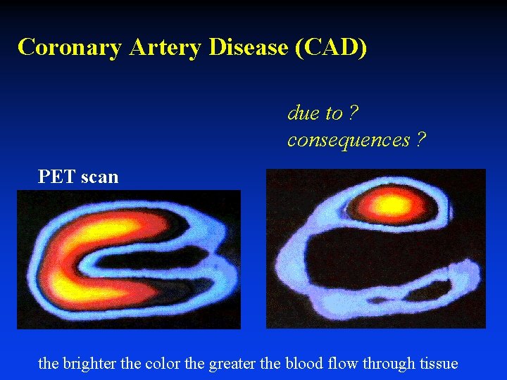 Coronary Artery Disease (CAD) due to ? consequences ? PET scan the brighter the