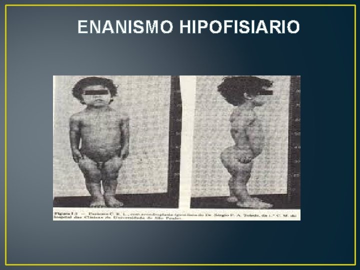 ENANISMO HIPOFISIARIO 