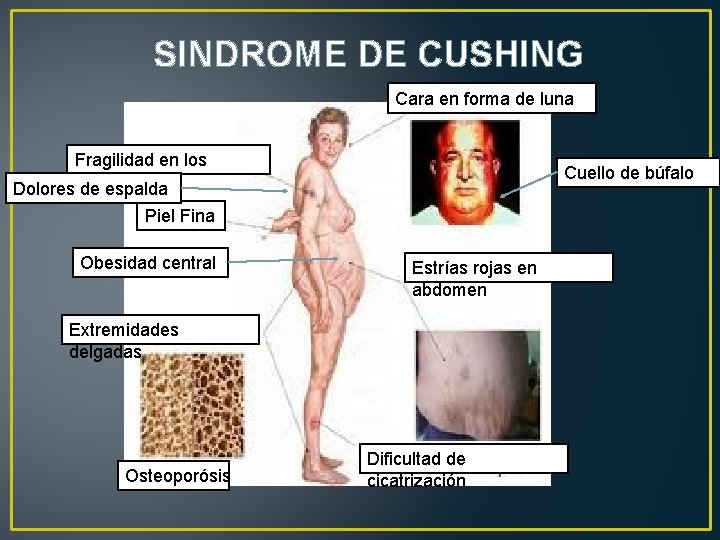 SINDROME DE CUSHING Cara en forma de luna Fragilidad en los Doloreshuesos de espalda