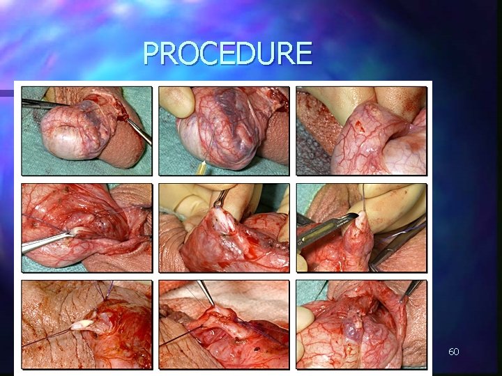 PROCEDURE 60 