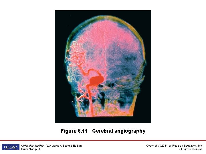 Figure 6. 11 Cerebral angiography Unlocking Medical Terminology, Second Edition Bruce Wingerd Copyright ©