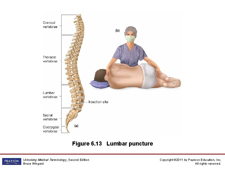Figure 6. 13 Lumbar puncture Unlocking Medical Terminology, Second Edition Bruce Wingerd Copyright © Figure 6. 13 Lumbar puncture Unlocking Medical Terminology, Second Edition Bruce Wingerd Copyright ©