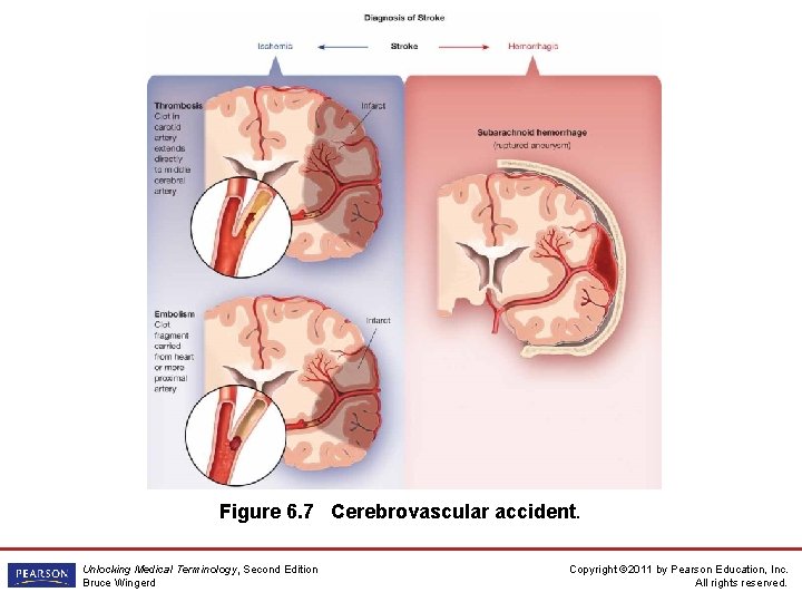 Figure 6. 7 Cerebrovascular accident. Unlocking Medical Terminology, Second Edition Bruce Wingerd Copyright ©