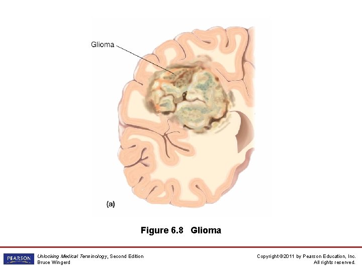 Figure 6. 8 Glioma Unlocking Medical Terminology, Second Edition Bruce Wingerd Copyright © 2011