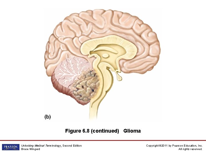 Figure 6. 8 (continued) Glioma Unlocking Medical Terminology, Second Edition Bruce Wingerd Copyright ©