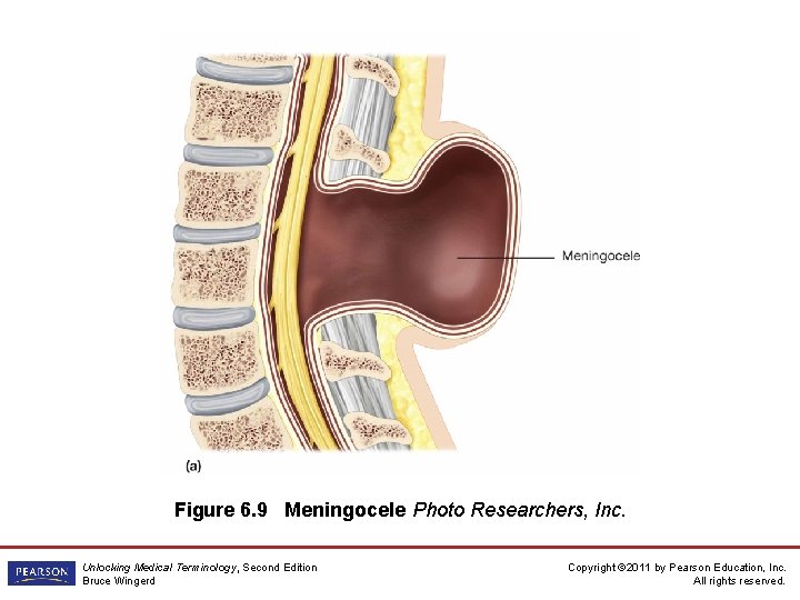 Figure 6. 9 Meningocele Photo Researchers, Inc. Unlocking Medical Terminology, Second Edition Bruce Wingerd Figure 6. 9 Meningocele Photo Researchers, Inc. Unlocking Medical Terminology, Second Edition Bruce Wingerd