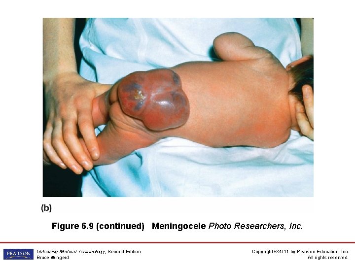 Figure 6. 9 (continued) Meningocele Photo Researchers, Inc. Unlocking Medical Terminology, Second Edition Bruce