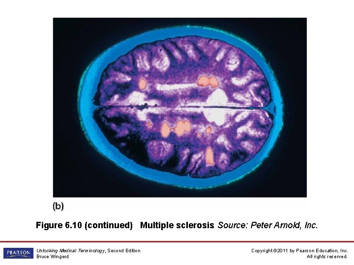 Figure 6. 10 (continued) Multiple sclerosis Source: Peter Arnold, Inc. Unlocking Medical Terminology, Second