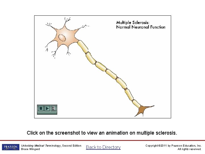 Multiple Sclerosis Animation Click on the screenshot to view an animation on multiple sclerosis.