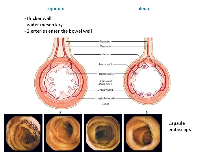 jejunum ileum - thicker wall - wider mesentery - 2 arteries enter the bowel