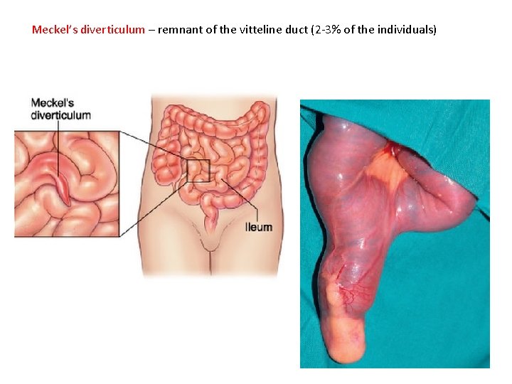 Meckel’s diverticulum – remnant of the vitteline duct (2 -3% of the individuals) 