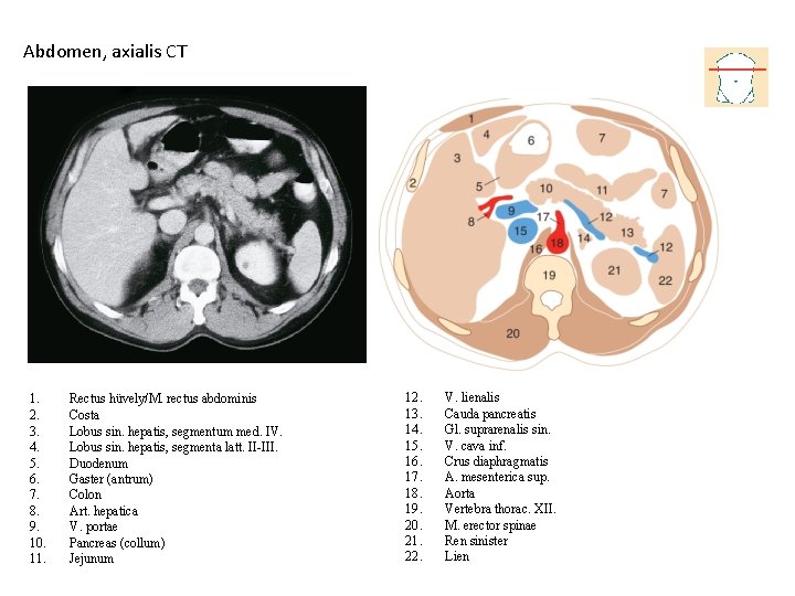 Abdomen, axialis CT 1. 2. 3. 4. 5. 6. 7. 8. 9. 10. 11.