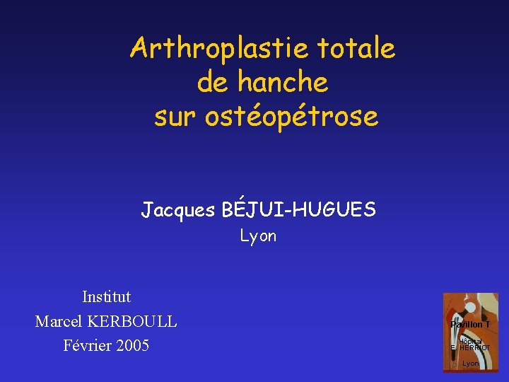 Arthroplastie totale de hanche sur ostéopétrose Jacques BÉJUI-HUGUES Lyon Institut Marcel KERBOULL Février 2005