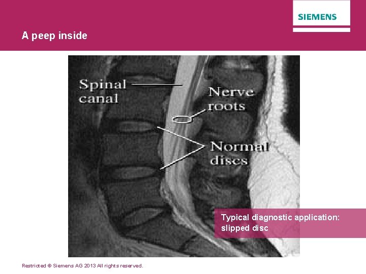 A peep inside Typical diagnostic application: slipped disc Restricted © Siemens AG 2013 All