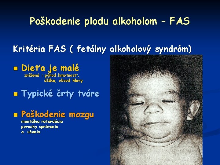 Poškodenie plodu alkoholom – FAS Kritéria FAS ( fetálny alkoholový syndróm) n Dieťa je