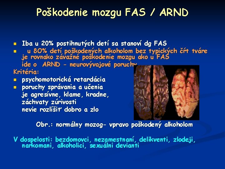 Poškodenie mozgu FAS / ARND Iba u 20% postihnutých detí sa stanoví dg FAS