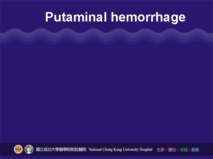 How serious is hemorrhagic stroke in Taiwan About