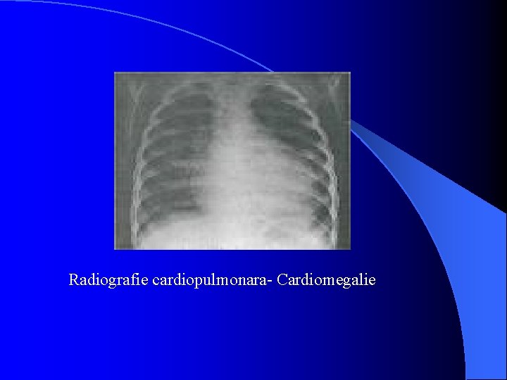 Radiografie cardiopulmonara- Cardiomegalie 