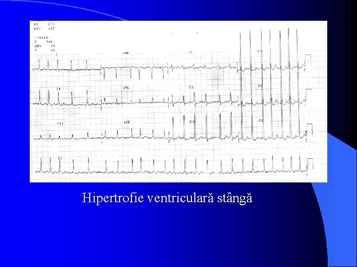 Hipertrofie ventriculară stângă 