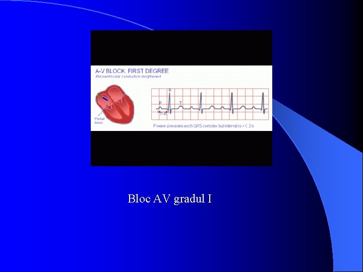 Bloc AV gradul I 
