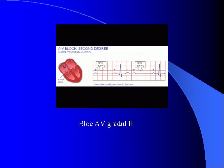 Bloc AV gradul II 