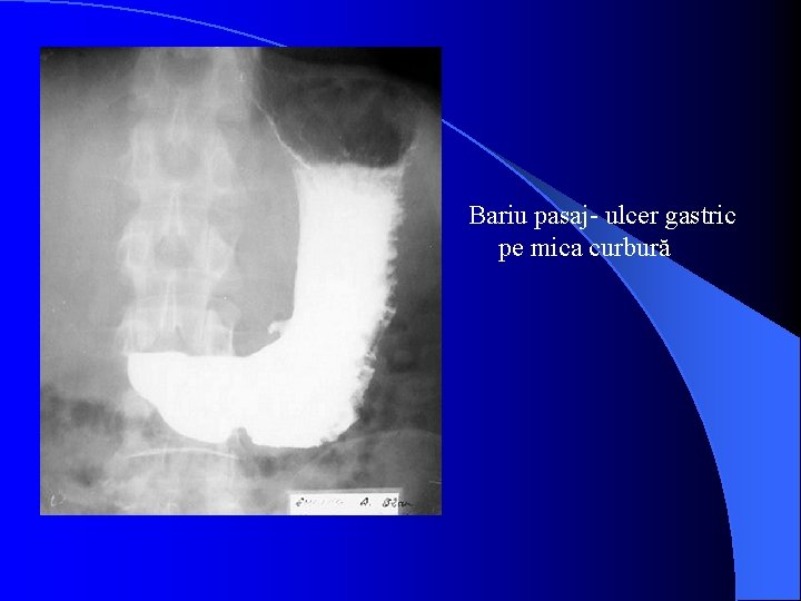 Bariu pasaj- ulcer gastric pe mica curbură 