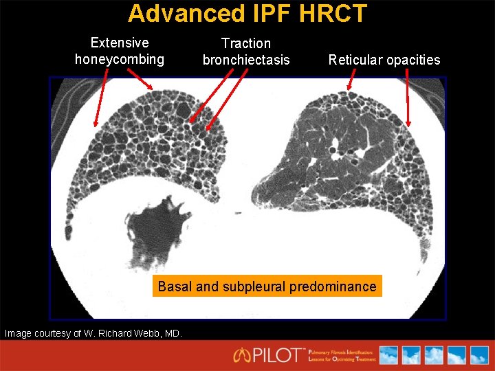 Advanced IPF HRCT Extensive honeycombing Traction bronchiectasis Reticular opacities Basal and subpleural predominance Image
