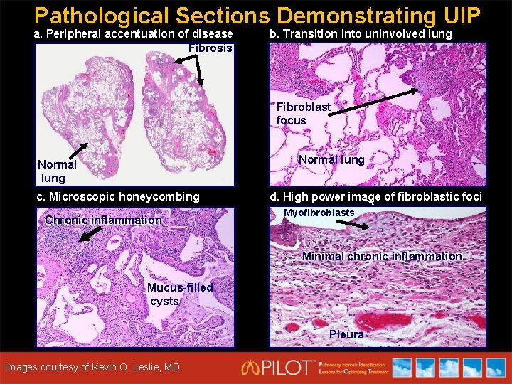 Pathological Sections Demonstrating UIP a. Peripheral accentuation of disease Fibrosis b. Transition into uninvolved