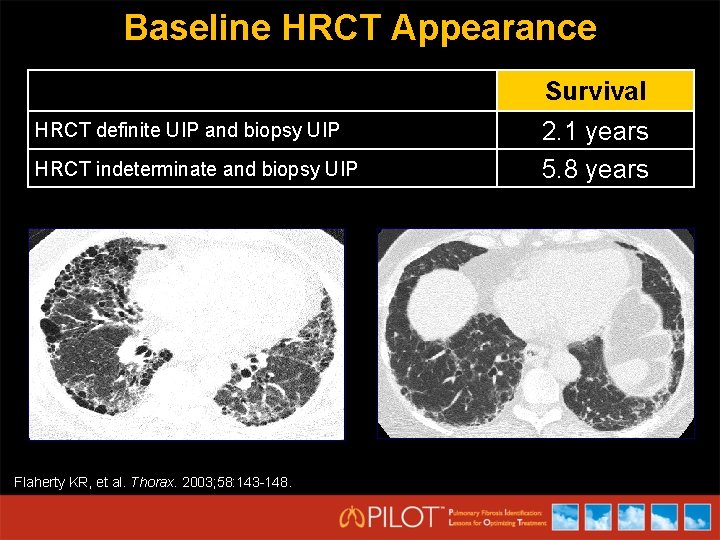 Baseline HRCT Appearance Survival HRCT definite UIP and biopsy UIP HRCT indeterminate and biopsy