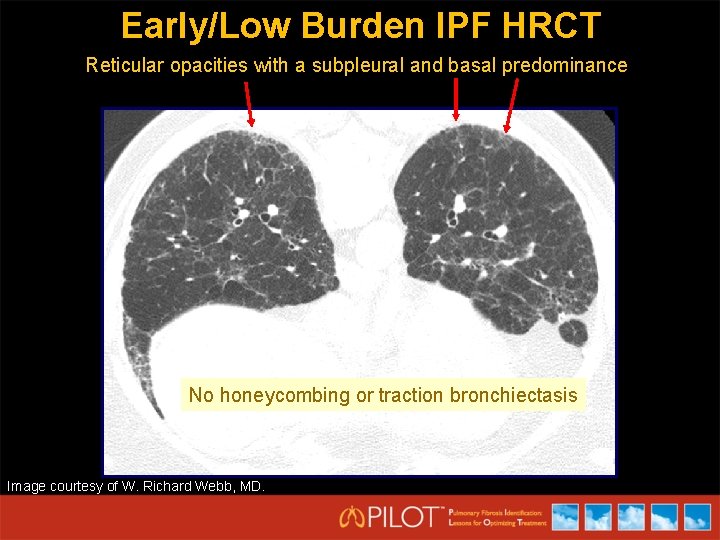 Early/Low Burden IPF HRCT Reticular opacities with a subpleural and basal predominance No honeycombing