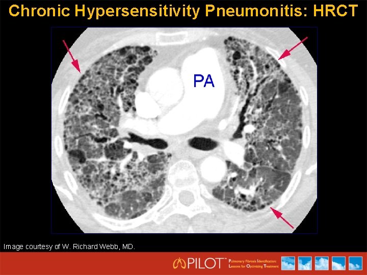 Chronic Hypersensitivity Pneumonitis: HRCT Image courtesy of W. Richard Webb, MD. 