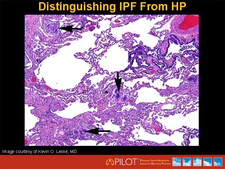 Distinguishing IPF From HP Image courtesy of Kevin O. Leslie, MD. 