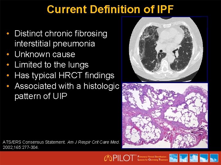 Current Definition of IPF • Distinct chronic fibrosing interstitial pneumonia • Unknown cause •