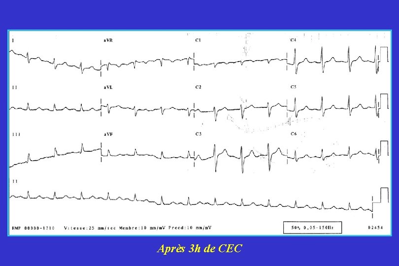 Après 3 h de CEC 