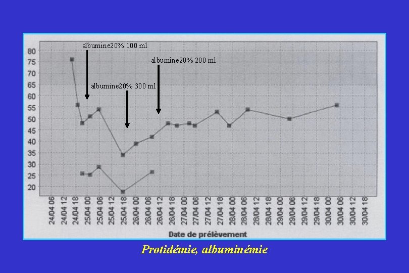 albumine 20% 100 ml albumine 20% 200 ml albumine 20% 300 ml Protidémie, albuminémie