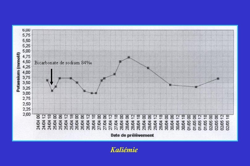 Bicarbonate de sodium 84‰ Kaliémie 